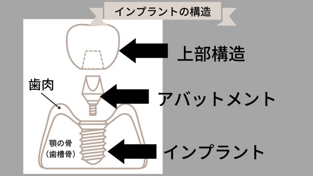 田町駅直結の歯科|プルチーノ歯科東京院のインプラント治療の特徴